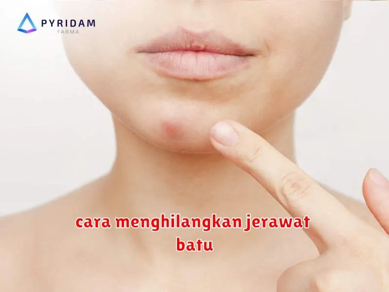 cara menghilangkan jerawat batu